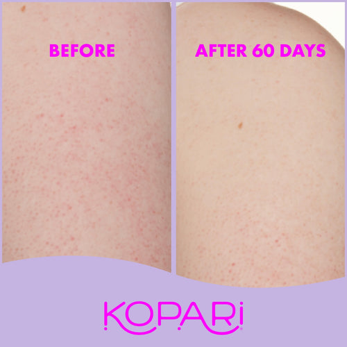 Mini KP Body Bumps Be Gone Scrub 